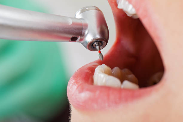 Best Emergency Wisdom Teeth Removal in Allouez, WI